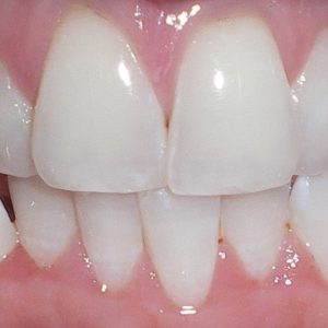 Clear Aligner Before 3