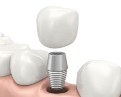 Dental Implants 1 Modesto, CA | Sierra Dental Care
