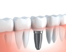 Dental Implants 2 Modesto, CA | Sierra Dental Care