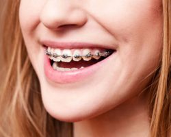 Orthodontics 1 Modesto, CA | Sierra Dental Care